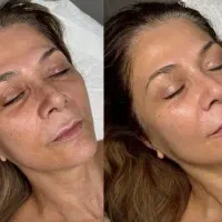 لیزرموزائدتیتانیوم ویژه روز مادر ۵۹۰تومن|خدمات آرایشگری و زیبایی|گرگان, |دیوار