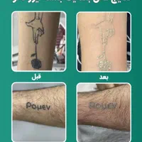 لیزر مو زائدآقاخانم(کل بدن رایگان) شعبه دوم|خدمات آرایشگری و زیبایی|نجف‌آباد, بازار|دیوار