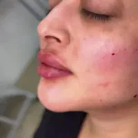 نیازمند مدل تزریق ژل|خدمات آرایشگری و زیبایی|ارومیه, |دیوار