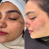 حذف تک جلسه ای لک و کک مک کلینیک|خدمات آرایشگری و زیبایی|رشت, گلسار|دیوار