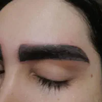 لیزر پاک کردن تاتو بدن و صورت