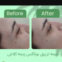جشنواره ویژه هایفو تراپی بوتاکس ژل لب گونه|خدمات آرایشگری و زیبایی|تهران, نارمک|دیوار