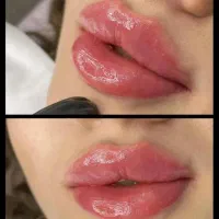 تزریق ژل وفیلر لب و گونه وچانه ومزو(جشنواره)درمطب
