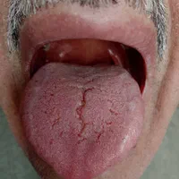 تشخیص عارضه و بیماری از روی زبان سونو گرافی زبان