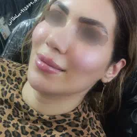 جشنواره تخفیف محرم میکروبلیدینگ فیلر ژل