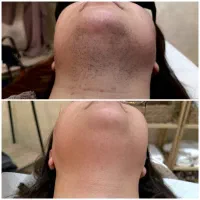 لیزر غیر تماسی دکا ایتالیا ۲۰۲۵ فول ۷۹۰ت