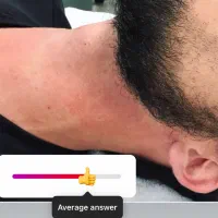 لیزر موهای زائد آقایان