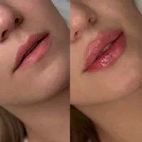 فیلر و بوتاکس توسط پزشک مجرب