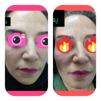 مزو میکرو نیدلینگ ،جوانسازی|خدمات آرایشگری و زیبایی|همدان, |دیوار