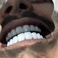 کامپوزیت دندان ، اصلاح طرح لبخند ، لمینت|خدمات آرایشگری و زیبایی|تهران, نظامی گنجوی (توانیر)|دیوار