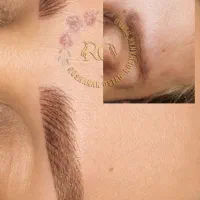 ترمیم تاتو های قدیمی بدون دردسر ریمو