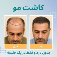 کاشت مو/ فول تراکم/ متد FIT/ بدون نیاز به جراحی|خدمات آرایشگری و زیبایی|تهران, دروس|دیوار