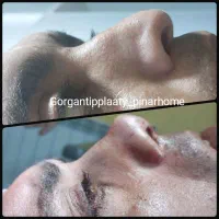 تیپ پلاستی نوک بینی با بی حسی بدون بیهوشی