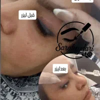 پاک کردن تاتو صورت و بدن با دستگاه لیزر