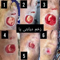 درمان تخصصی زخم‌ دیابتی‌ و زخم‌ بستر|خدمات آرایشگری و زیبایی|شیراز, شهرک پرواز|دیوار