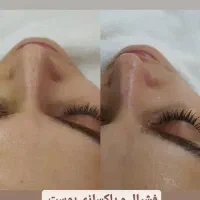 فشیال و پاکسازی پوست ، ایپیلاسیون