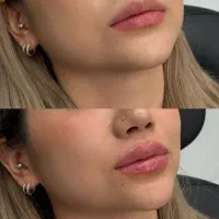 جشنواره ویژه کاشت ابرو ،بوتاکس، فیلر ..