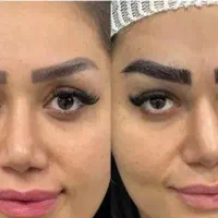 فشیال پاک سازی ،،برداشتن تتو بدن وابرو