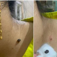 برداشت خال با خلال دندان