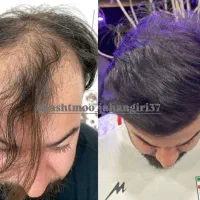 کاشت مو تضمینی