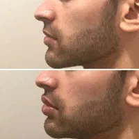 خدمات ژل ، بوتاکس، مزوتراپی ،فشیال و کامپوزیت|خدمات آرایشگری و زیبایی|اهواز, ۲۴ متری|دیوار