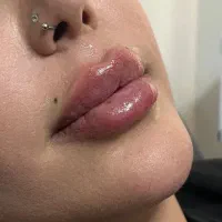 مدل تزریق ژل فیلر  بوتاکس