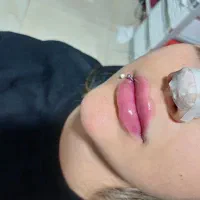 آف ژل بوتاکس مزو