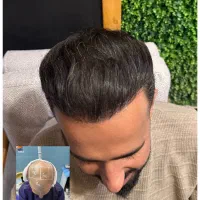 کاشت مو با ضمانت مادام العمر. انستاگرامzana.kasht|خدمات آرایشگری و زیبایی|مریوان, |دیوار