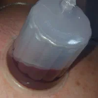 حجامت و فصد و فیزیوتراپی