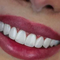 شرایط ویژه کامپوزیت دندان