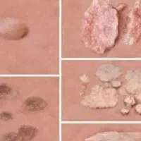 پاکسازی زگیل تناسلی وتبخال تناسلی