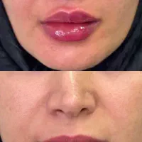 جشنوارتخفیفات ژل و بوتاکس توسط شخص پزشک|خدمات آرایشگری و زیبایی|قم, زنبیل آباد|دیوار