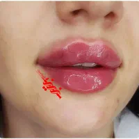 تزریق فیلر ژل و بوتاکس در کلینیک|خدمات آرایشگری و زیبایی|بندرعباس, |دیوار