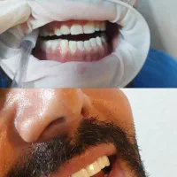 آف ویژه خدمات تخصصی کامپوزیت دندان|خدمات آرایشگری و زیبایی|شاهین‌شهر, فردوسی|دیوار