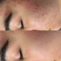 مدل پاکسازی صورت و فیشیال فوری فقط هزینه مواد|خدمات آرایشگری و زیبایی|اهواز, پردیس دو|دیوار