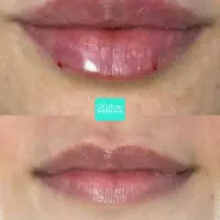 تزریق چربی و ژل با 5سال سابقه کاری
