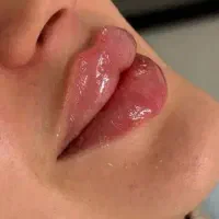 آموزش تزریق فیلر و بوتاکس