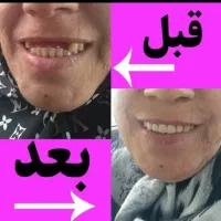 لابراتواردندانسازی مهتاب تعمیرات دندان مصنوعی شما