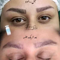 ریموو تتو صورت،پذیرش مدل محدود،تخفیف تا ۲ میلیون