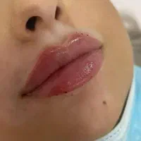 جشنواره بوتاکس تخفیف 50درصد در بیمارستان فقط امروز|خدمات آرایشگری و زیبایی|تهران, فلسطین (میدان انقلاب)|دیوار