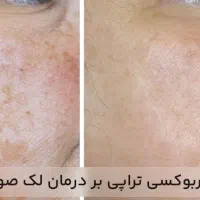 کربوکسی تراپی|خدمات آرایشگری و زیبایی|رفسنجان, |دیوار