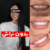 کامپوزیت لمینت ایمپلنت (اقساط۱۸ماه)(فقط در ۱ جلسه)