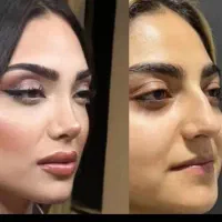 جشنواره لیپو ابدو ۷۵عمل بینی ۳۵ تومن اسلیو تهران