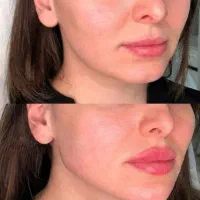 تزریق ژل لب فیلر زاویه سازی صورت فک گونه بوتاکس|خدمات آرایشگری و زیبایی|فردیس, خیام شرقی|دیوار
