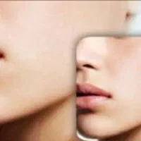 برداشت خال وزگیل ومیخچه وبخیه زیبایی