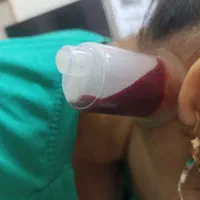 درمان بیماریها با حجامت