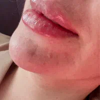 ژل بوتاکس ژل لب فیلرزیر چشم مزوتراپی مزوژل|خدمات آرایشگری و زیبایی|شیراز, کاراندیش|دیوار
