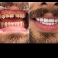 تخفیفات کامپوزیت ،لمینت
