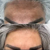 پاکسازی فشیال vip