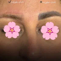 تخفیف 50% ریمو تتو ابرو با لیزر